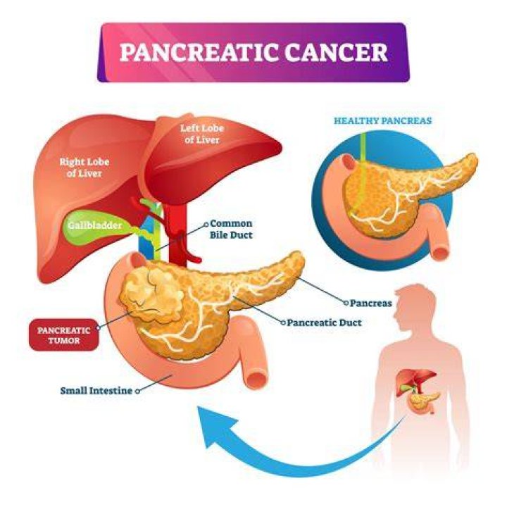 Video | Pancreatic Cancer: From Screening to Treatment